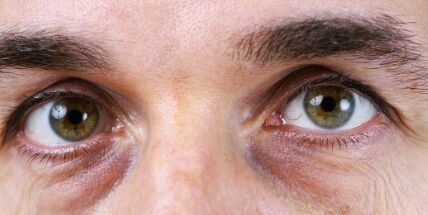 Serviço de Preenchimento da olheira com ácido hialurônico